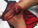 wpid-shauns-fractured-fibula-compound-ankle-dislocation-playing-baseball-warning-graphic-fracture-image-21312923.jpg