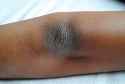 Dark-skin-on-elbows-is-more-common-on-African-American-skin-e1432457663211.jpg