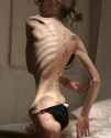 anorexia_nervosa.jpg
