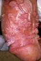 warts.jpg