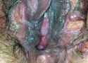 blue-waffle-infection-403x288[1].jpg