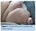 obese foot and leg.jpg