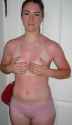 becca burnt.jpg