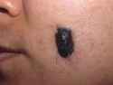 4c3a411279df4d1d2ad268a1c005ac88--skin-moles-on-back.jpg