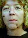 Hairy-moles.jpg