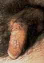 Condyloma-acuminatum-of-penis.jpg