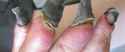 sepsis-gangrene-fingers _f_600x250.jpg