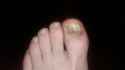 Toe jam...jpg