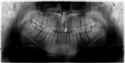 Keenan_James_16012017_153413 (tooth xray).jpg