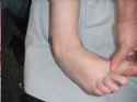 Chronic Ankle Instability.jpg