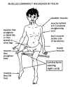 muscle atrophy caused by polio.gif