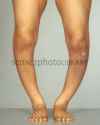 Rickets (Osteomalacia).jpg