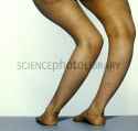 C0094076-Rickets.jpg