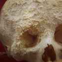 Bone-Cancer.jpg