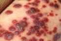 800px-kaposis_sarcoma.jpg