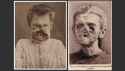 congenital-syphilis.jpg
