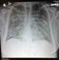 ARDS Radiograph2.jpg