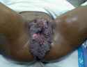 Blue-Waffles-Disease-in-Women.jpg